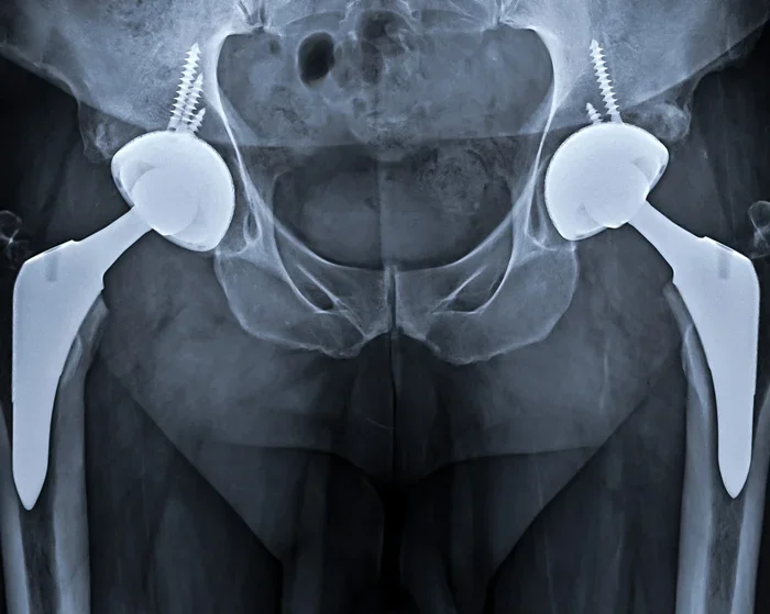 Can I Use an Elliptical After Hip Replacement