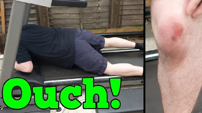 How Long Do Treadmill Burns Take to Heal